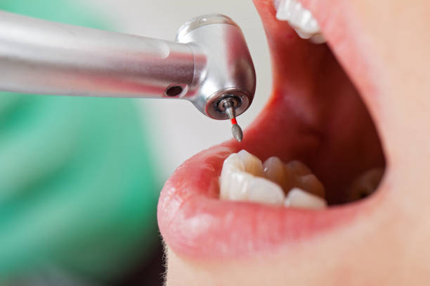 Best Emergency Dentist for Lost Fillings or Crowns in Tri City, OR
